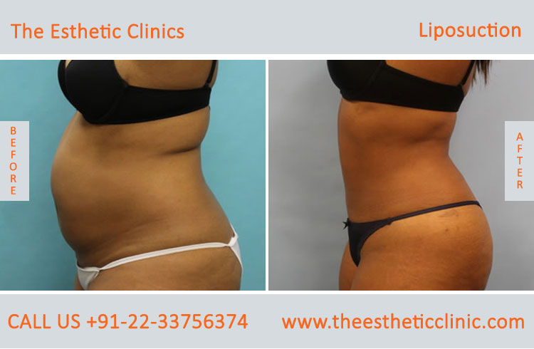 Liposuction Fat Removal Treatment before after photos in mumbai india (6)